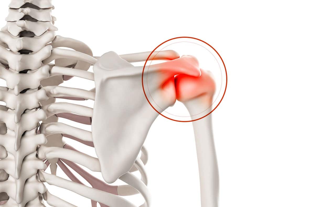Chirurgie de l’épaule à Paris: Acromioplastie de l’épaule - Dr Paillard, Chirurgien orthopédique