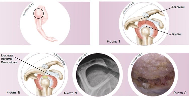 Qu’est ce qu’un conflit sous-acromial de l’épaule? Définition par dr Paillard: Chirurgien orthopédique