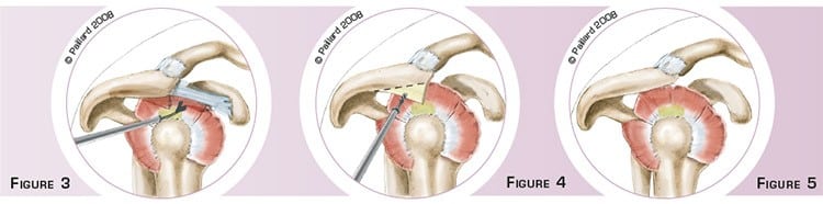 Acromioplastie de l’épaule à Paris par docteur Paillard: Chirurgien orthopédique