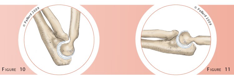 Chirurgie du coude (Arthrolyse du coude) à Paris par docteur Paillard