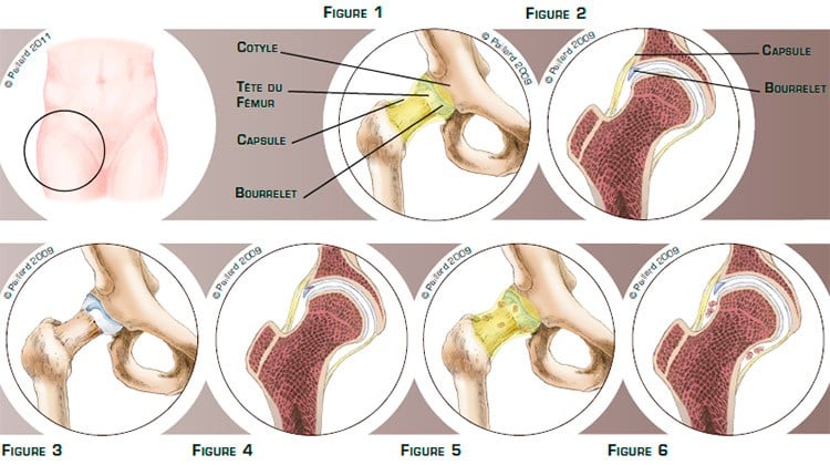 Qu’est ce qu’une pathologie intra-articulaire de la hanche? Définition par dr Paillard