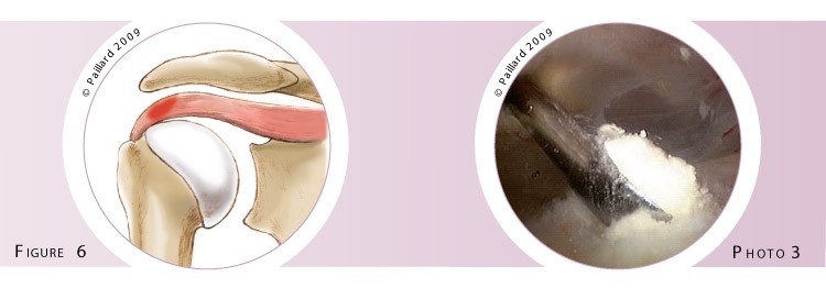 Chirurgie calcification des tendons de l’épaule à Paris - Dr Paillard, Chirurgien orthopédique