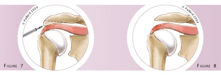 Traitement des calcifications de l’épaule à Paris - Dr Paillard, Chirurgien orthopédique