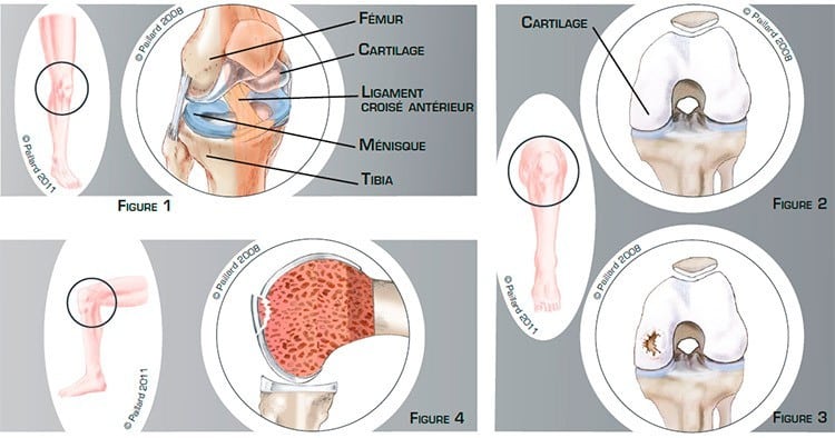 Qu’est ce qu’une lésion cartilagineuse du genou? Définition par dr Paillard