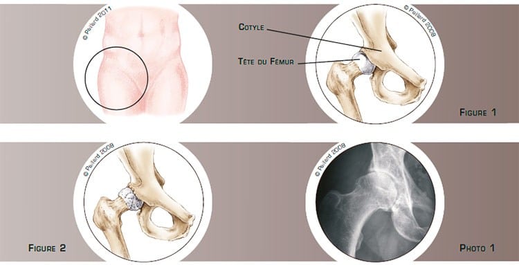 Qu’est ce qu’une prothèse totale de hanche par voie antérieure? Définition par dr Paillard