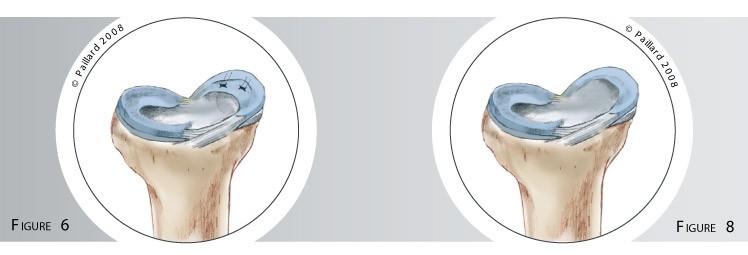 Qu’est ce qu’une chirurgie méniscale? Définition par dr Paillard, Chirurgien orthopédique