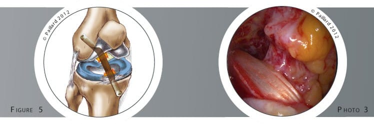 Qu’est ce qu’une ligamentoplastie du croisé antérieur sous arthroscopie? Définition par dr Paillard