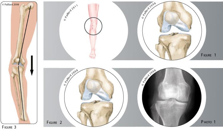 Traitement de l'arthrose interne débutante du genou à Paris - Dr Paillard