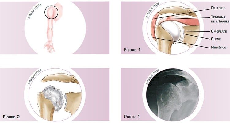 Qu’est ce qu’une arthrose de l’épaule? Définition par dr Paillard: Chirurgien orthopédique