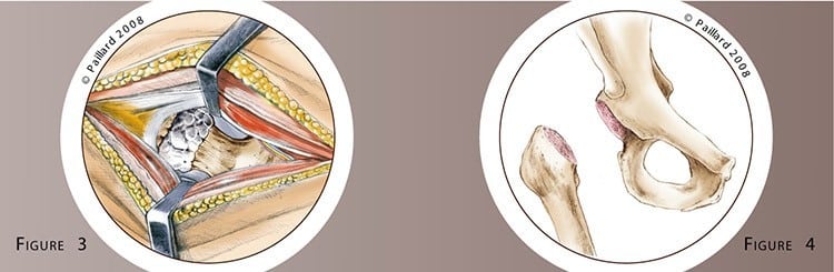 Prothèse totale de la hanche: Chirurgie par Dr Paillard à Paris