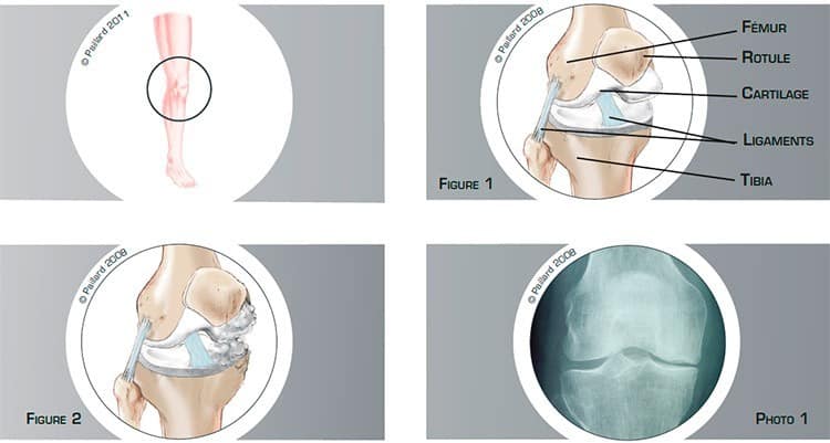 Qu’est ce qu’une arthrose partielle du genou? Définition par dr Paillard