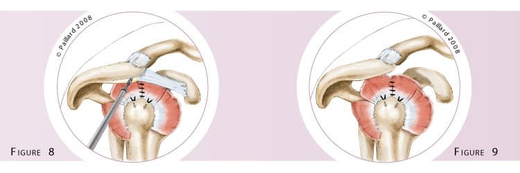 Réparation arthroscopique des tendons de l’épaule à Paris - Dr Paillard