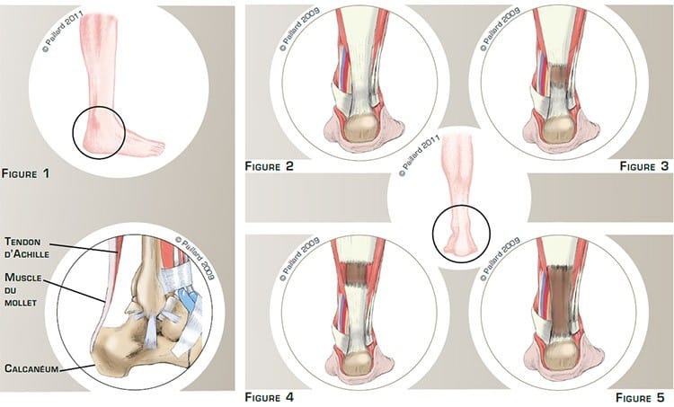 Rupture du tendon d’Achille: Définition par dr Paillard, Chirurgien orthopédique à Paris