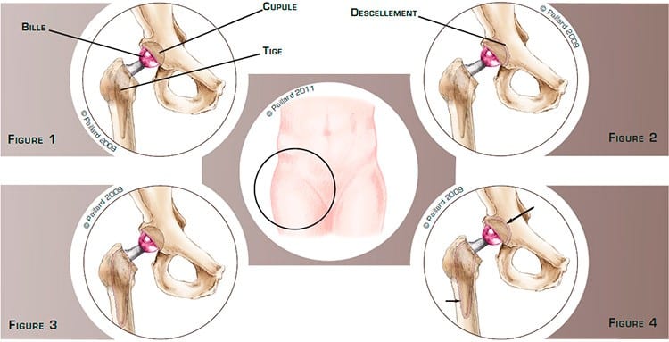 Qu’est ce qu’un descellement de prothèse de hanche? Définition par dr Paillard