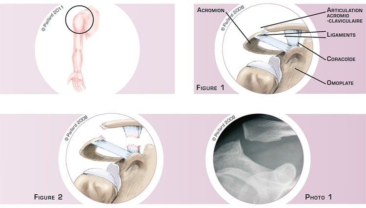Qu’est ce qu’une stabilisation acromio claviculaire? Définition par dr Paillard