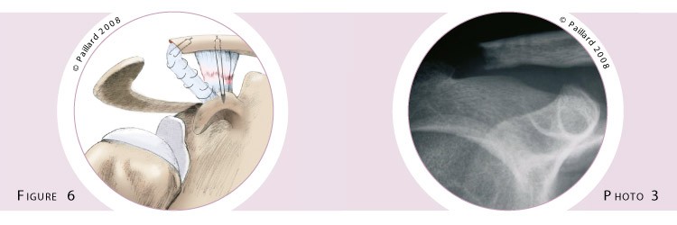 Stabilisation acromio-claviculaire (Chirurgie de l’épaule) à Paris par docteur Paillard