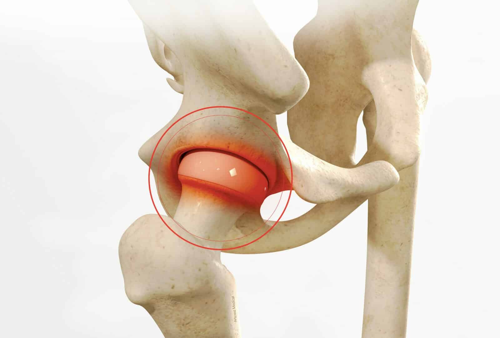 Chirurgie de la hanche à Paris: Arthroscopie de la hanche - Dr Paillard