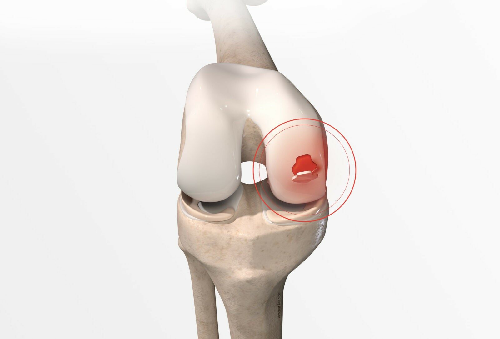 Chirurgie du genou à Paris: Chirurgie cartilagineuse du genou - Dr Paillard