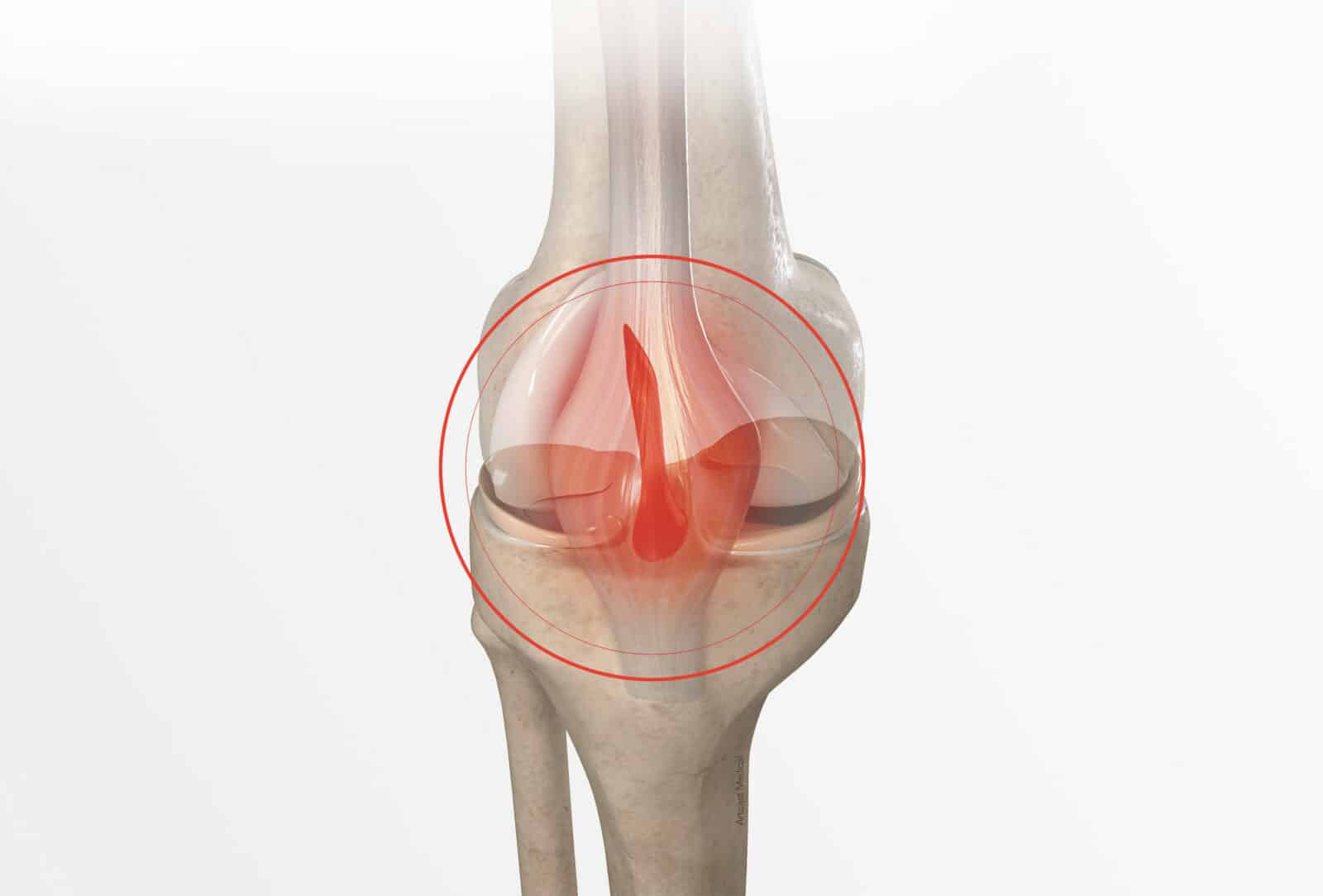 Ligamentoplastie du croisé antérieur à Paris - Dr Paillard