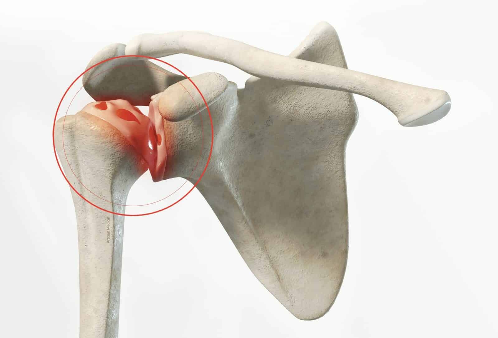 Chirurgie de l’épaule (Prothèse totale de l’épaule) à Paris par docteur Paillard