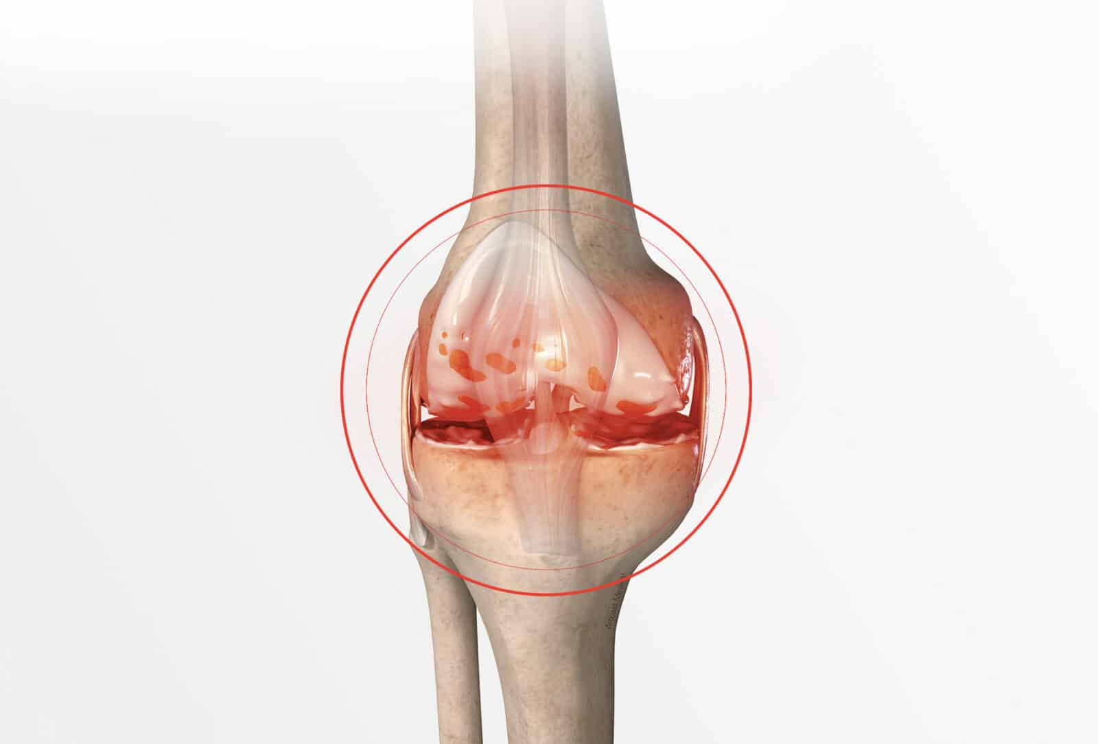 Chirurgie du genou à Paris: Prothèse totale du genou - Dr Paillard