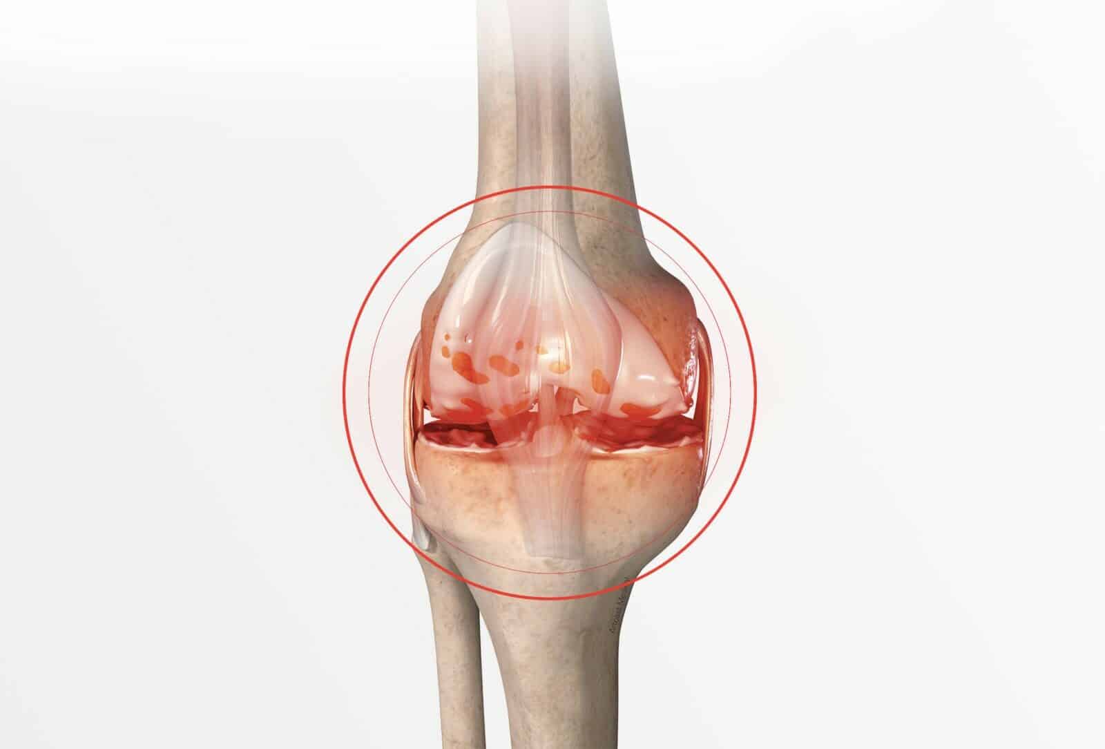 Prothèse unicompartimentale du genou à Paris - Dr Paillard