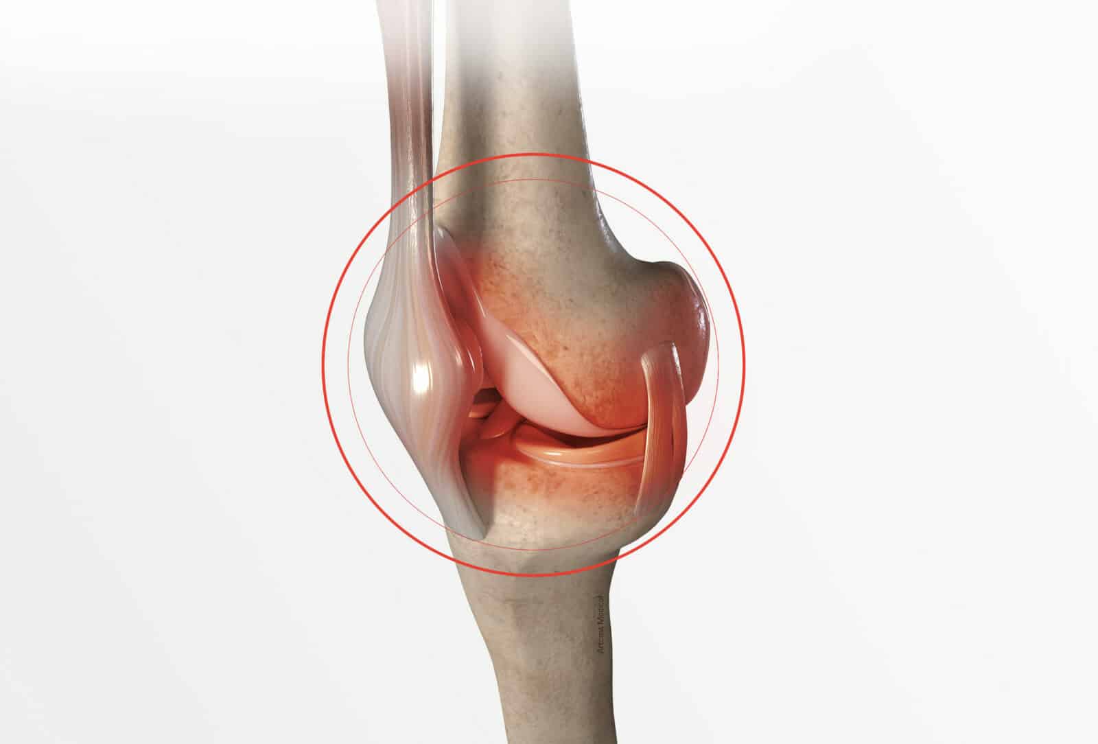 Chirurgie du genou à Paris: Recentrage rotulien - Dr Paillard