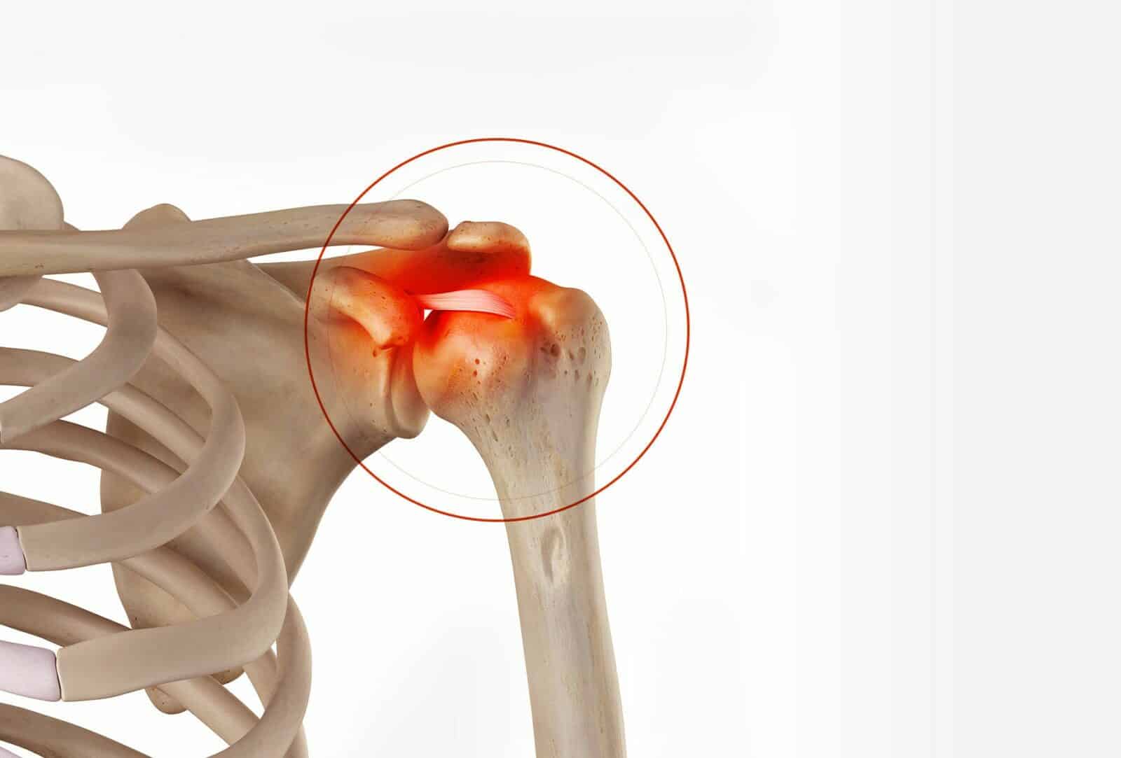 Chirurgie de l’épaule à Paris: Stabilisation acromio-claviculaire - Dr Paillard