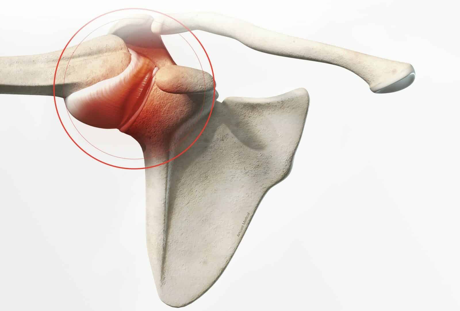 Chirurgie de l’épaule à Paris: Stabilisation acromio-claviculaire - Dr Paillard Paris